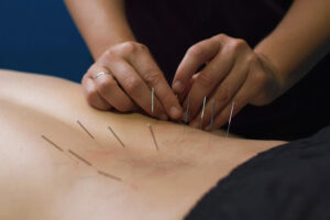 needling therapy at home